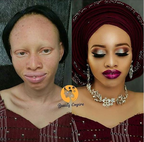Transformation An Albino Lady » Naijafinix