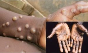Lagos Leads As Monkeypox Spreads To 26 States