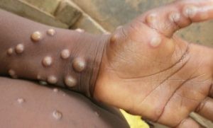 US Declares Monkeypox A Public Health Emergency